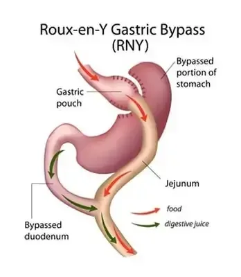 Gastric Bypass Surgery Melbourne