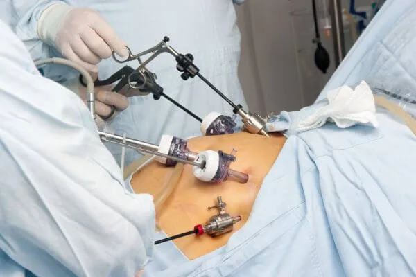 Gastric Band (Lap Band Surgery)