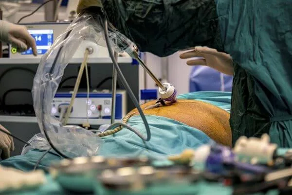 Gastric Bypass Procedure Melbourne
