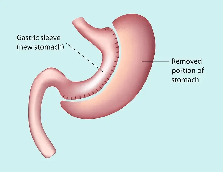 Gastric Sleeve