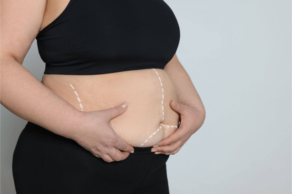 Complications and Obesity Related Health Conditions